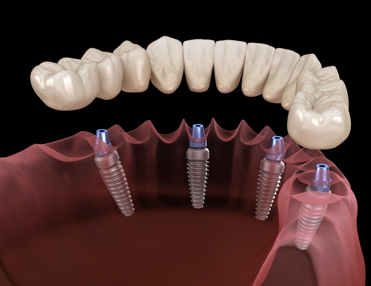 Esquema 3D de una prótesis fija completa atornillada sobre cuatro implantes dentales (técnica All-on-4)