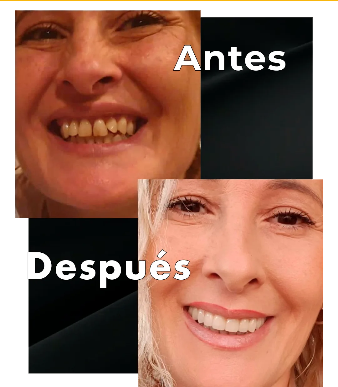 Antes y después de una rehabilitación de boca completa con implantes en Centre Mèdic Basté, Sant Boi de Llobregat