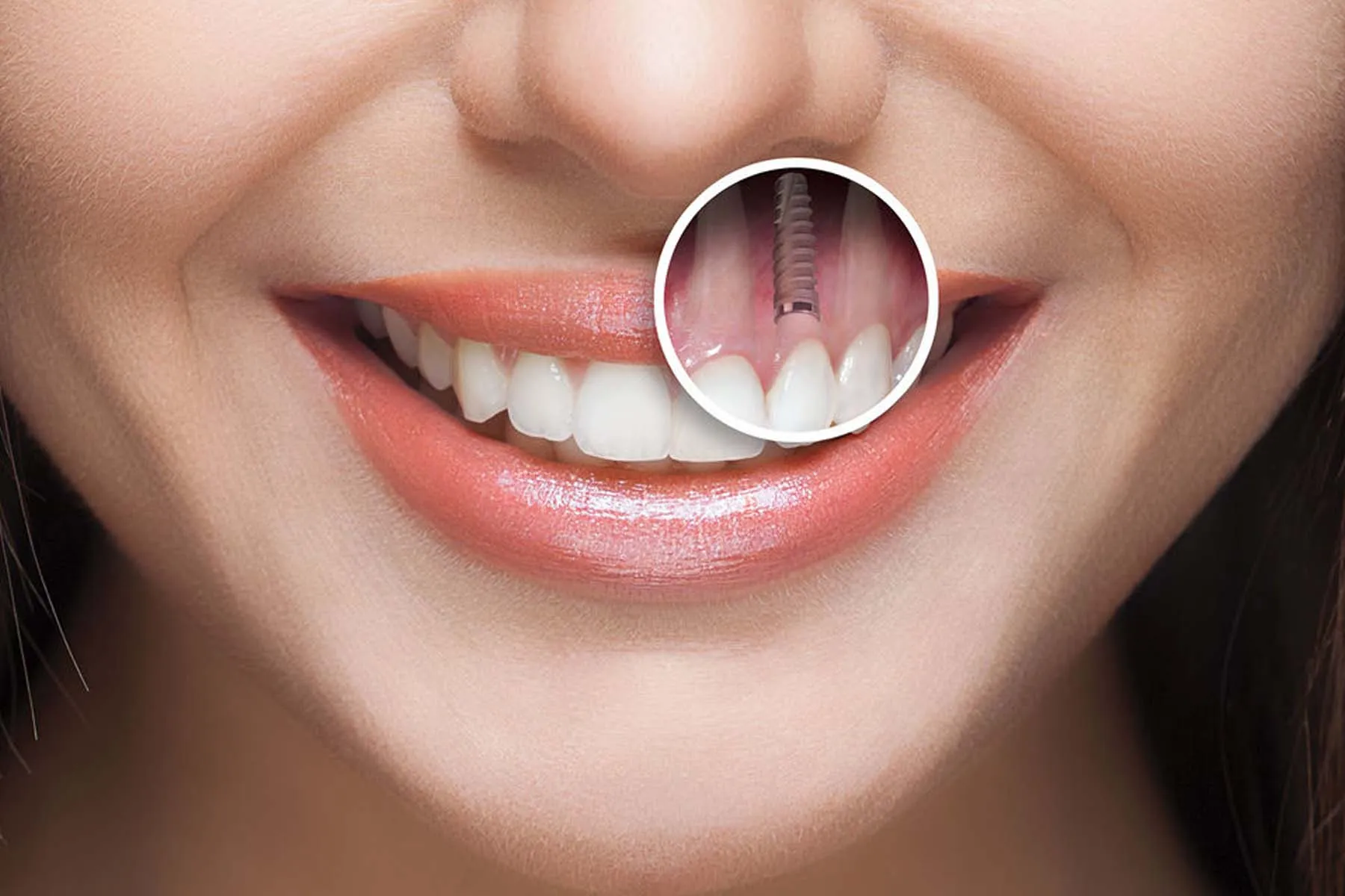Sonrisa con el detalle ampliado de un implante dental de titanio bajo la encía