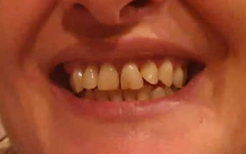 Antes - Sonrisa con el detalle ampliado de un implante dental de titanio bajo la encía