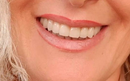 Después - Sonrisa con el detalle ampliado de un implante dental de titanio bajo la encía